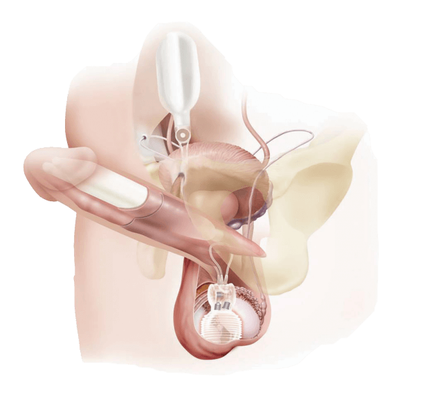 Tratamiento de la impotencia sexual con implantes de pene