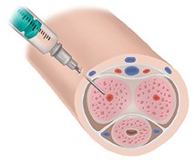 Tratamiento mediante inyección peneana